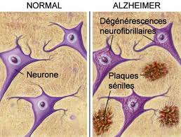 Alzheimer