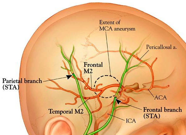 AVC : rupture d'anévrisme