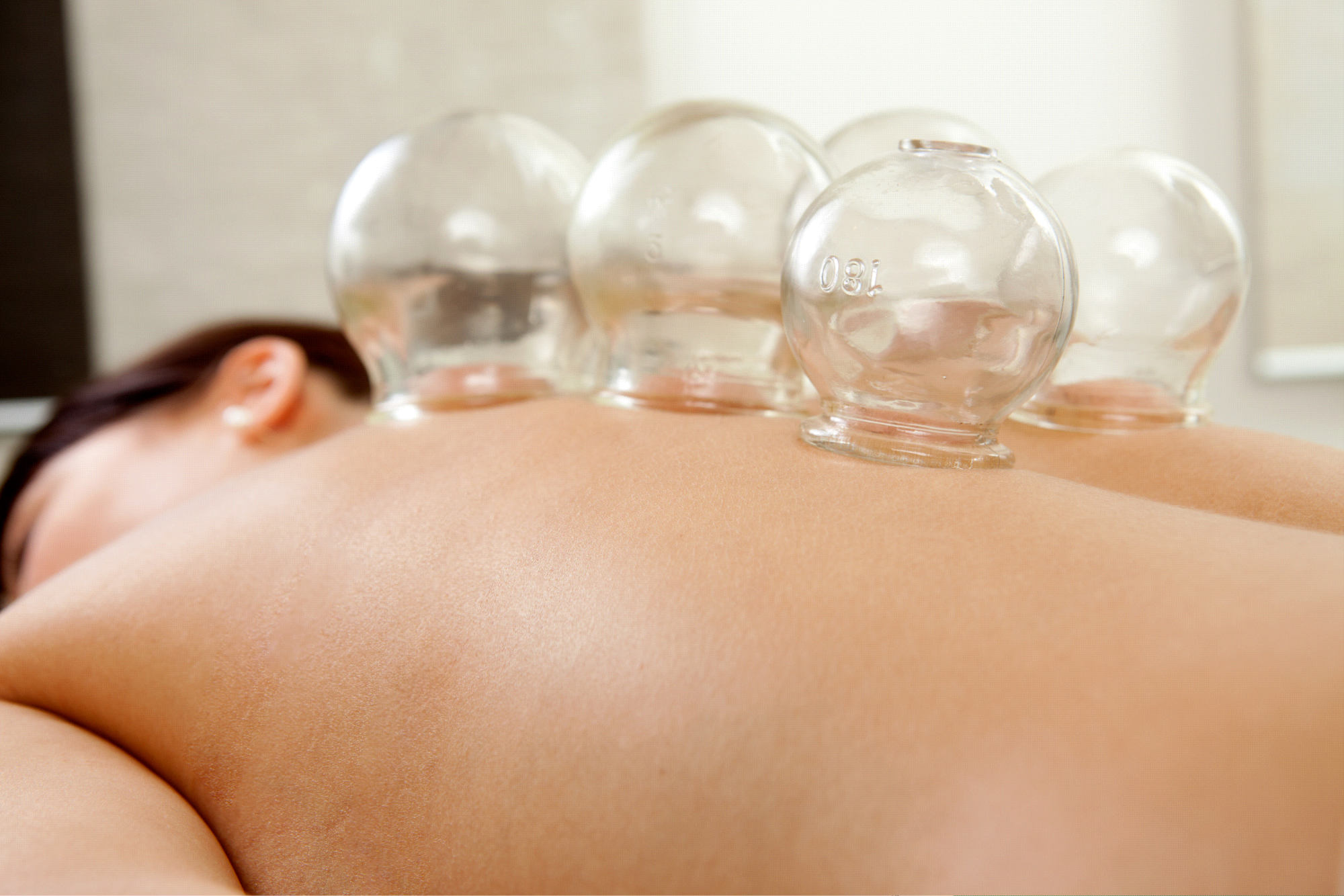 Cupping thérapie, hijama : savez-vous réellement de quoi il s’agit ?